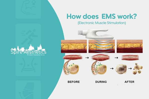 EMS treatment for post pregnancy weight loss treatment Bere Regis