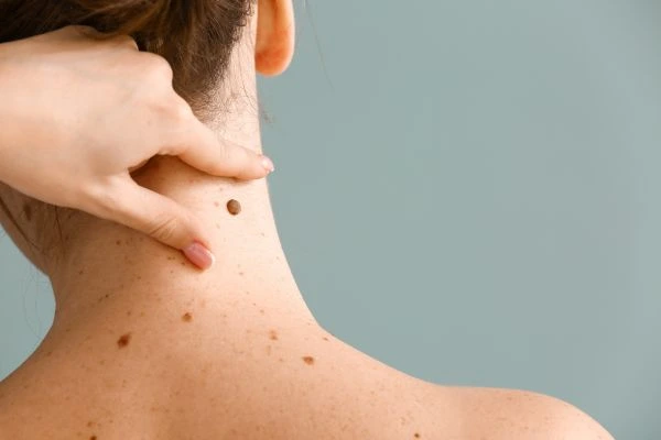 skin blemish removal Bere Regis treatment